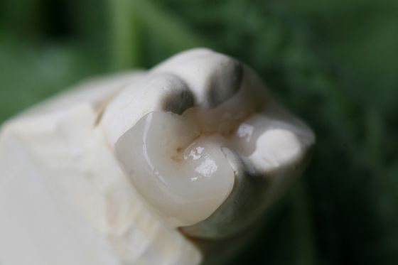Coroa dental artificial estética do Onlay e do embutimento EMAX