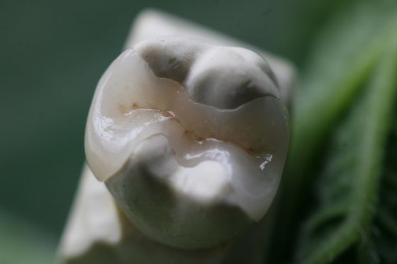 Coroa dental permanente da solução EMAX das próteses fixas