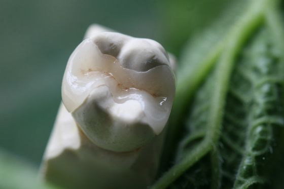 Natural olhar toda a porcelana folheia a coroa dental de EMAX