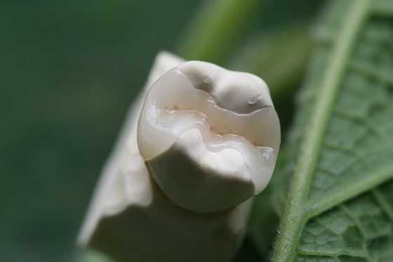 Coroa dental permanente da solução EMAX das próteses fixas