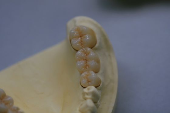 Coroa dental da zircônia dental da porcelana do óxido de zircônio do laboratório com cerâmico