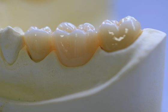 O laboratório dental fixou próteses mergulhou a coroa dental da zircônia para Front Teeth