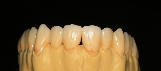 O laboratório dental fixou próteses mergulhou a coroa dental da zircônia para Front Teeth
