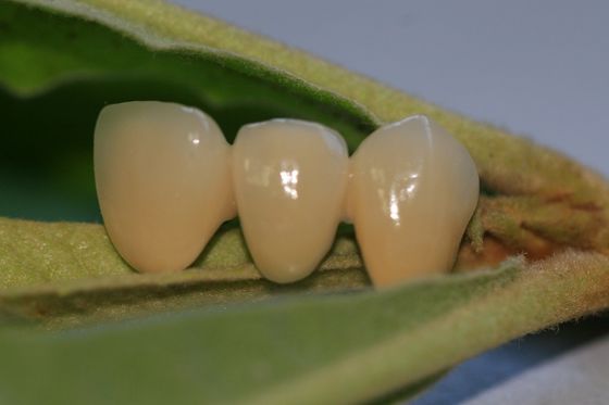 Coroa provisória composta da cor natural da resina para os dentes anteriores