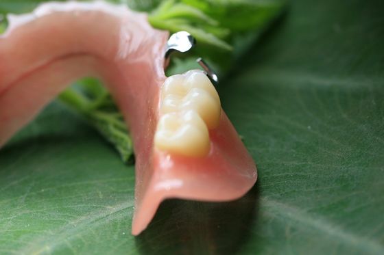 Dentadura parcial acrílica removível parcial