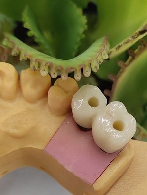 Os implantes dentais cimentados de NOBEL BIOCARE da solução coroam