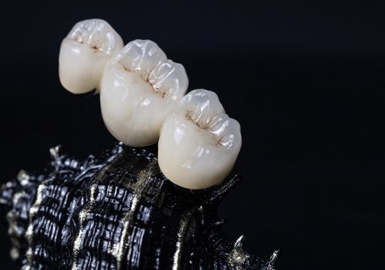 Coroa dental da estrutura PFM do metal