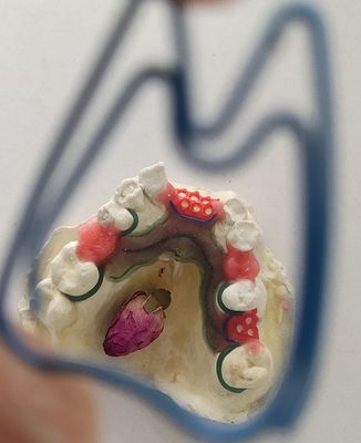 Estrutura parcial do metal da dentadura do Co do Cr