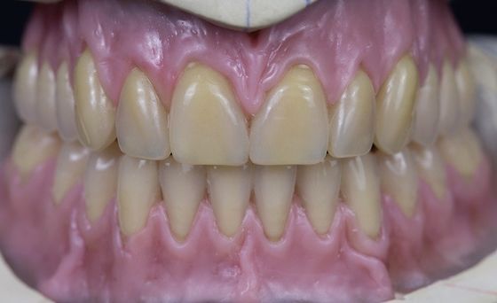 Dentadura completa acrílica removível curada quente do arco completo