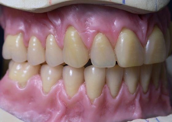 Dentadura completa acrílica removível curada quente do arco completo