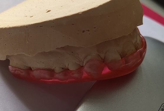 Protetor Maxillary acrílico duro For Bruxism da estabilização do arco