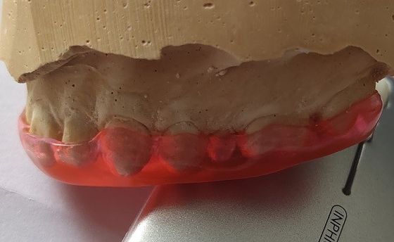 Protetor Trushine Bite Plane de Michigan para a moedura de dentes