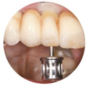 O ASC natural dobrou o canal que do parafuso os implantes dentais coroam