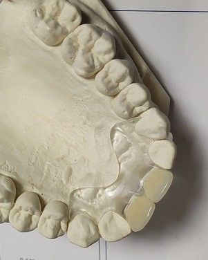 Dentadura invisível macia confortável do ajuste ISO13485 RPD