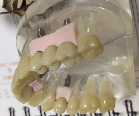 100 coroa provisória de Biocompatibility PMMA dos por cento