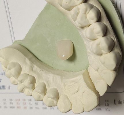 Coroa provisória composta da cor natural da resina para os dentes anteriores