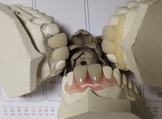 Dentadura invisível flexível parcial para os dentes anteriores