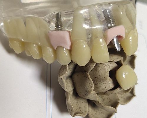 Placa do metal que mói a cópia 3D dental da coroa interna de PFM