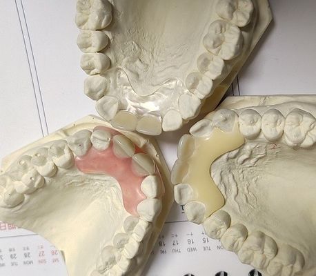 Dentadura invisível livre do metal da resina para o paciente alérgico