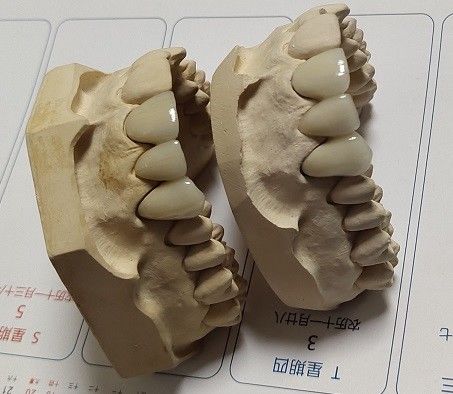 Coroa do CAD CAM PFM da porcelana