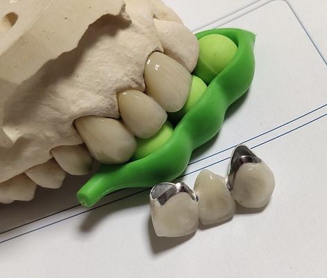 Coroa do CAD CAM PFM da porcelana