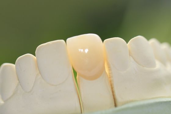 Coroa dental cerâmica do vidro permanente natural para os dentes anteriores