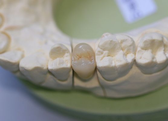 Coroas traseiros cerâmicas de vidro de Aesthethics EMAX para os molares