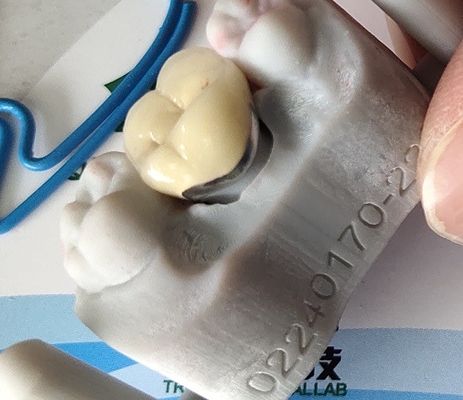 Porcelana dental da coroa do CAD CAM PFM do produto do laboratório fundida ao metal