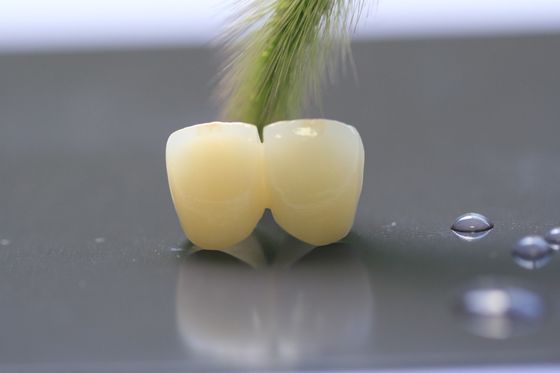 coroa dental do laboratório da estrutura PFM da cópia 3D para a odontologia