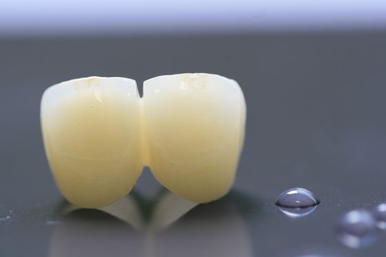coroa dental do laboratório da estrutura PFM da cópia 3D para a odontologia