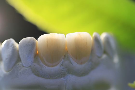 coroa dental do laboratório da estrutura PFM da cópia 3D para a odontologia