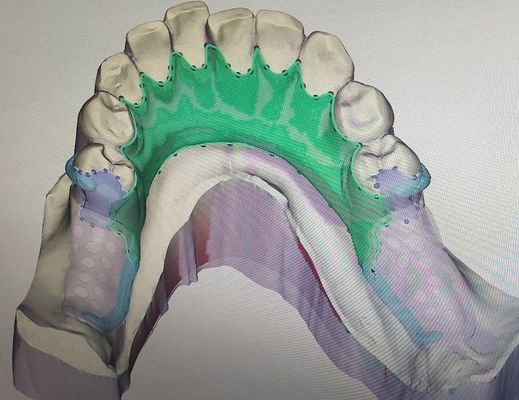 3D removível imprimiu a estrutura parcial do metal da dentadura