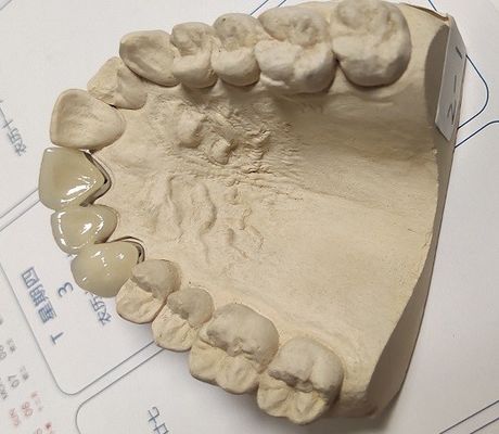 Coroa dental cerâmica da aptidão PFM do metal boa