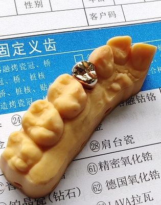 Coroa dental preciosa alta da liga de ouro da boa aptidão
