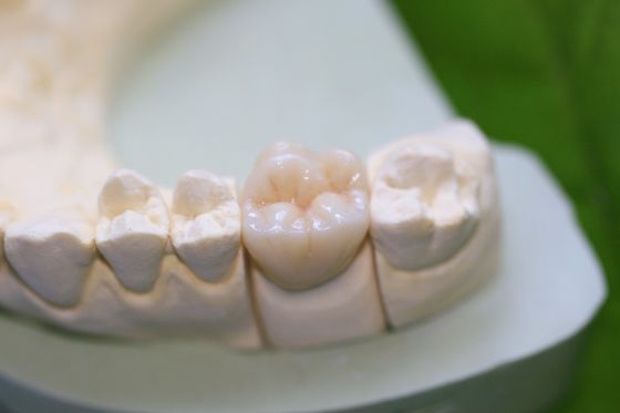 Coroas traseiros cerâmicas de vidro de Aesthethics EMAX para os molares